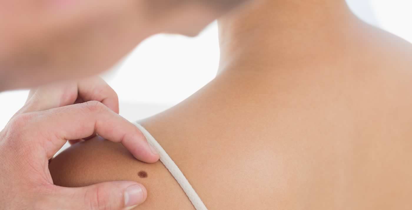 Prevención y diagnóstico del cáncer de piel
